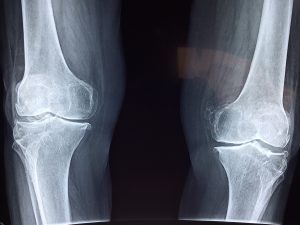X-ray image of knees